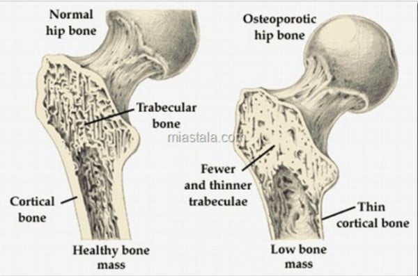 Tratament pentru Osteoporoza - Herbagetica