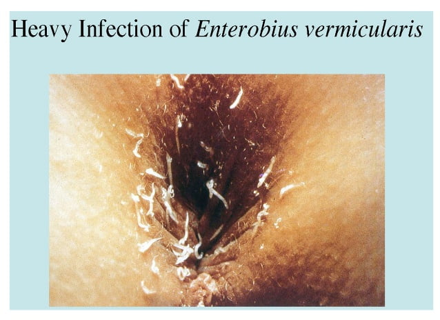 Parazitoze intestinale provocate de Oxiuri (Enterobius vermicularis)